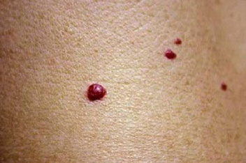 درباره خال های قرمز چه می دانید؟