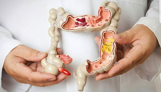 این رژیم غذایی خطر ابتلا به سرطان روده بزرگ را افزایش می‌دهد