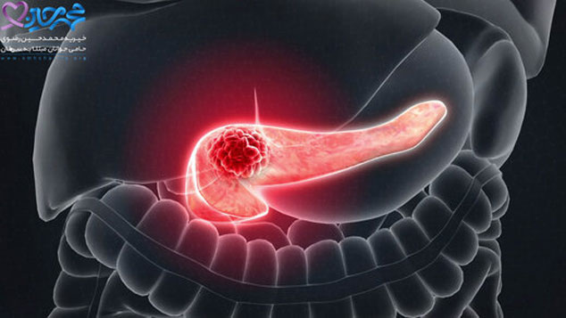 همه چیز درباره یک سرطان با علائم خاموش