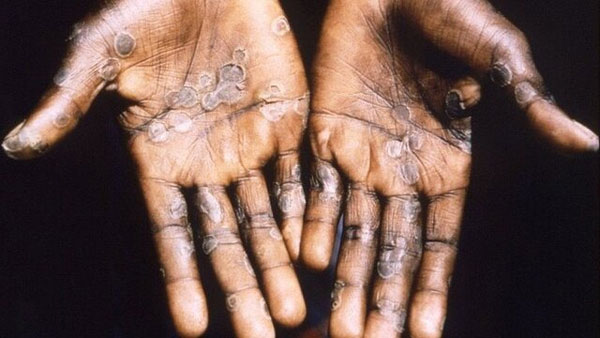 احتمال ورود بیماری مُهلک و خطرناک به ایران