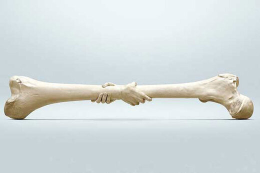 سن ابتلا به پوکی استخوان در کشور، کاهش یافت