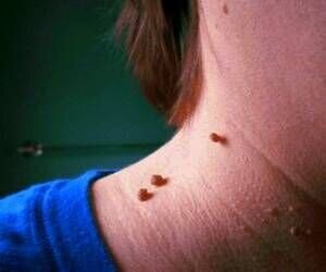 «خال» در چه صورت نشانه سرطان پوست است؟