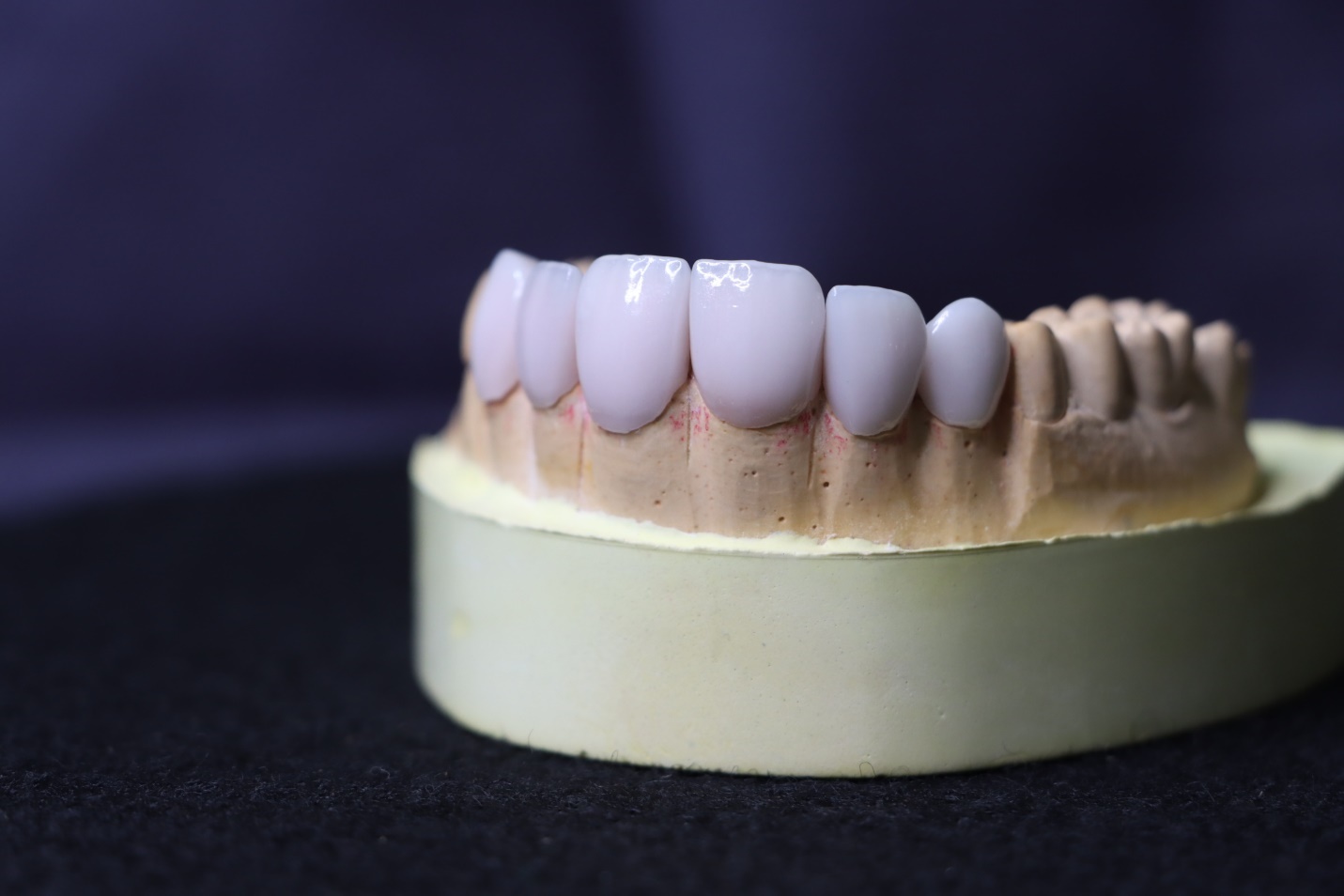 عمر لمینت دندان؛ دلایل وعوامل موثر بر آن