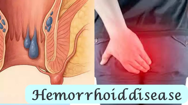 هموروئید (بواسیر): راهنمای جامع علت‌ها، علائم و روش‌های درمان در زنان و مردان