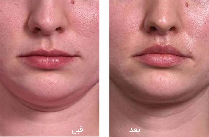 5 راهکار برای حجیم‌تر نشان دادن لب‌ها بدون جراحی
