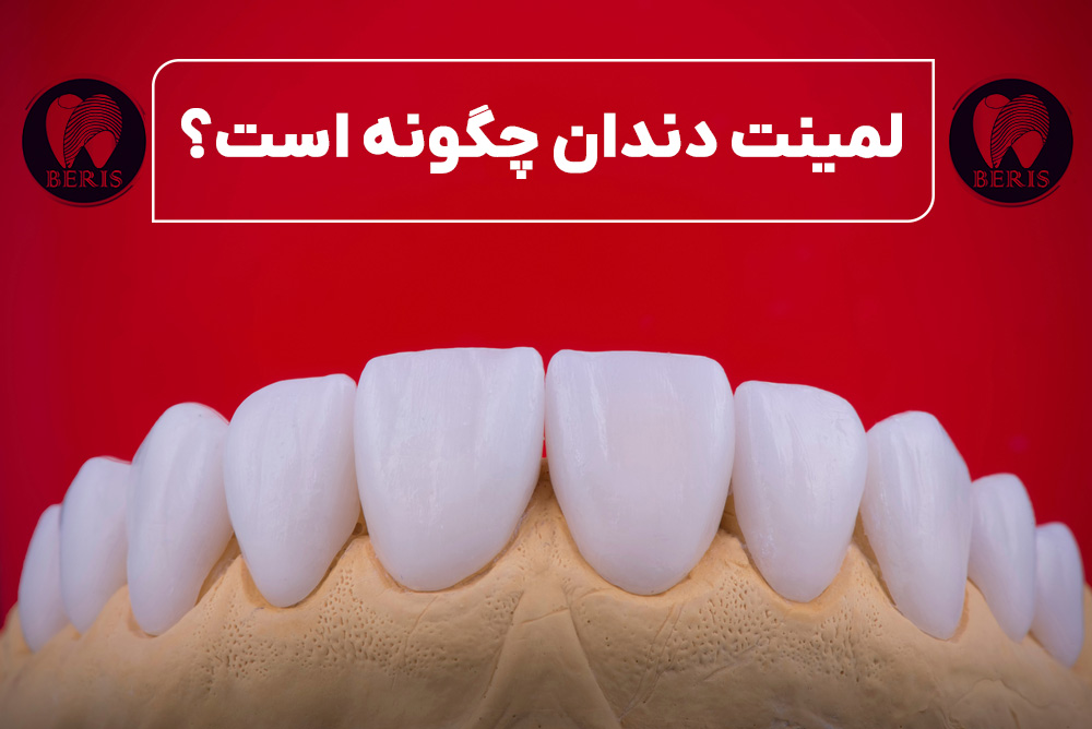 لمینت دندان چگونه است؟ یک راهکار بی‌نقص برای لبخندی بی‌عیب