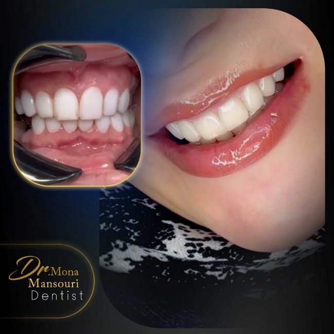 پشیمانی بعد از کامپوزیت دندان